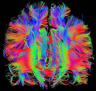 MRT Bild vom Gehirn